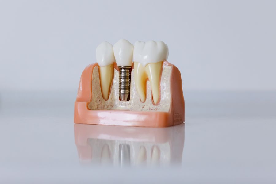 A dental implant model showing how an implant sits within the jaw